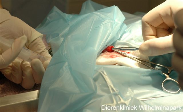 via een katheter wordt de blaas schoongespoeld